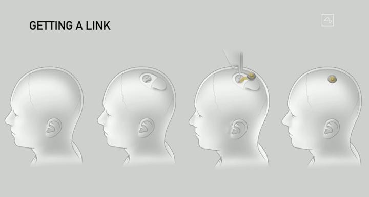 马斯克人脑接口概念股_马斯克提及Neuralink未来计划：2025年将为部分患者提供脑机接口植入_马斯克发明植入脑机接口